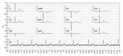 ECG Findings