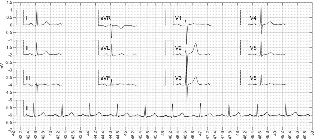 Normal 12-lead ECG trace from the clinical case